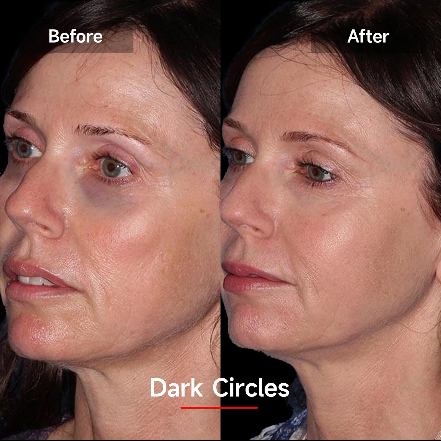 LASER&LED Light Therapy Mask