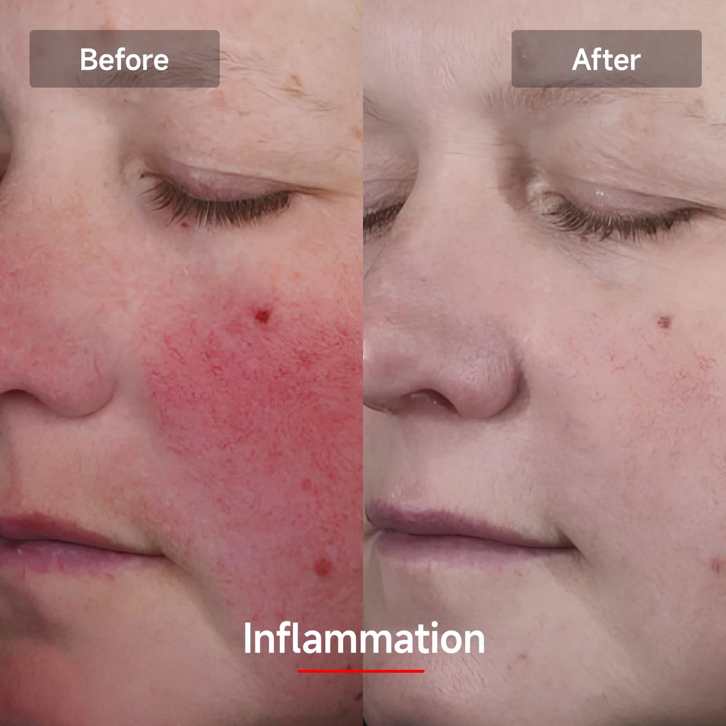 LASER&LED Light Therapy Mask