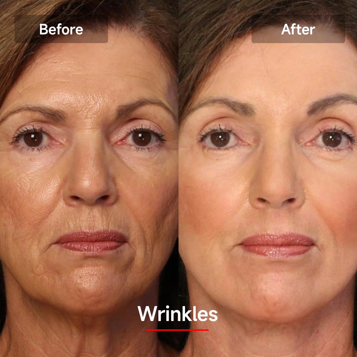 LASER&LED Light Therapy Mask