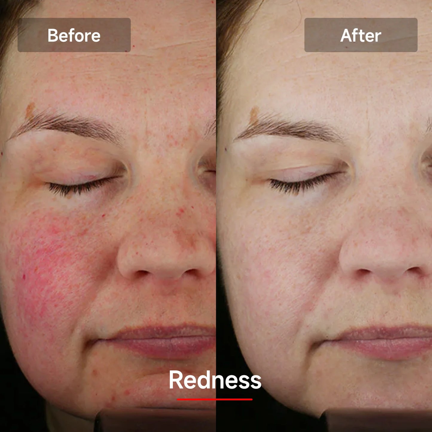 LASER&LED Light Therapy Mask